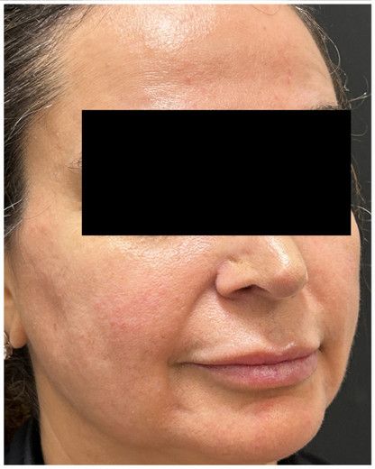 HIFU before — skin laxity, lower face sagging, jowl laxity, nasolabial folds, midface descent, front view