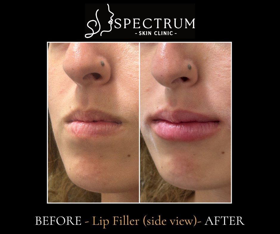 Lip Filler Before & After | Profile (Side View)