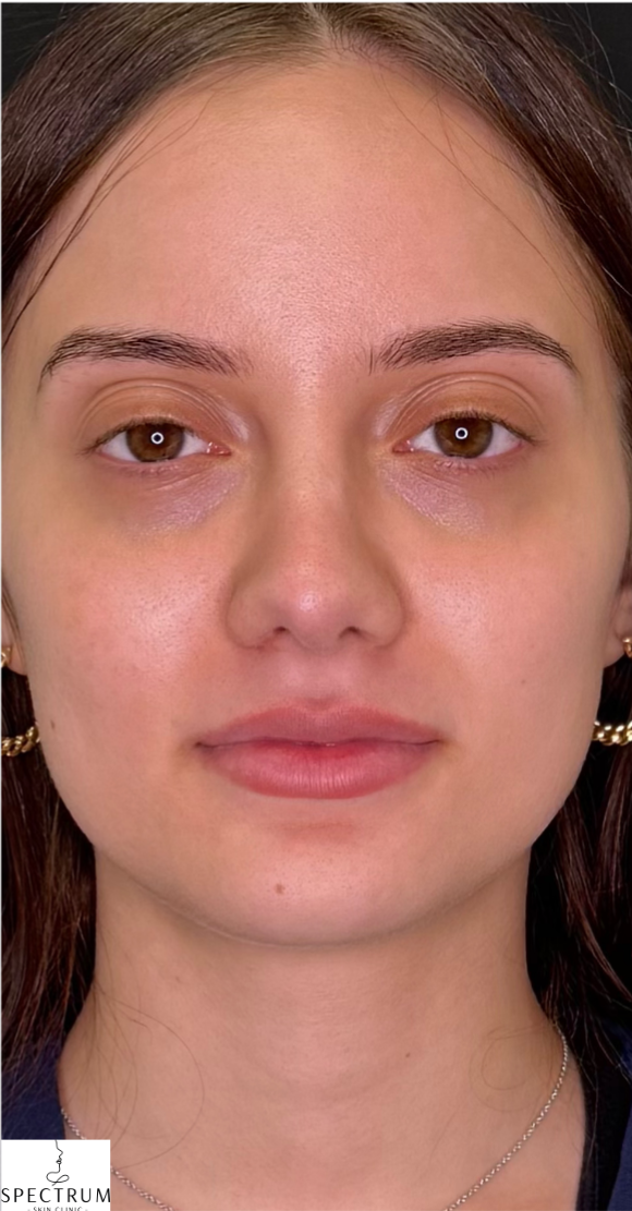 Lip Filler before — Volume and Definition, front view
