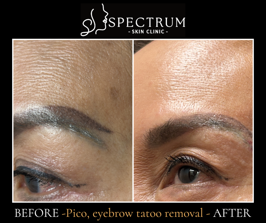 Eyebrow Tattoo Removal Before & After | Picoway Laser for Cosmetic Pigment Fading