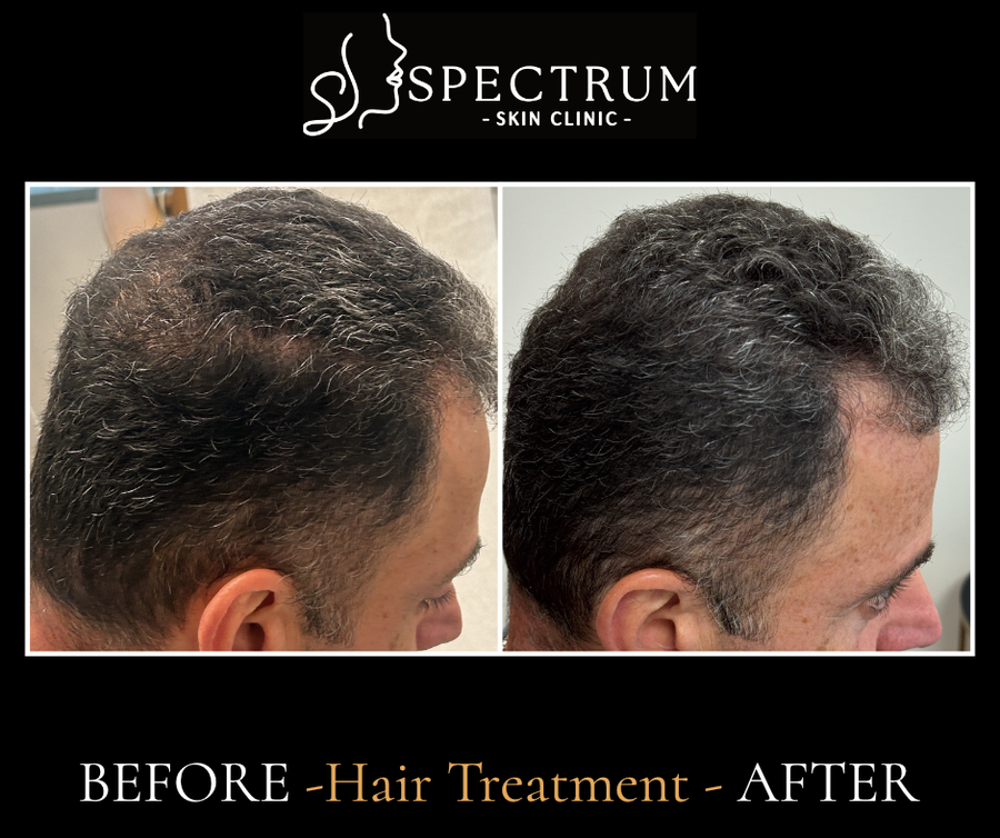 Exosome Hair Therapy Before and After, Male Crown Restoration at Spectrum Skin Clinic, Irvine