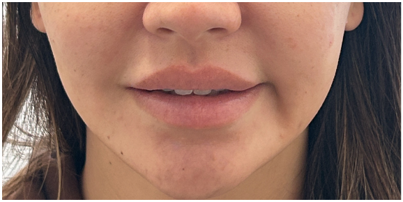 Lip Filler before — Thin Lips, front view