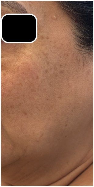Candela PicoWay, Pico Toning after — Brown Spots, Uneven Skin Tone, Hyperpigmentation, Sun Damage, front view