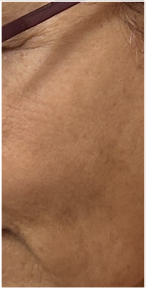 Pico Laser before — Hyperpigmentation, Sun Damage, Brown Spots, Solar Lentigines, front view