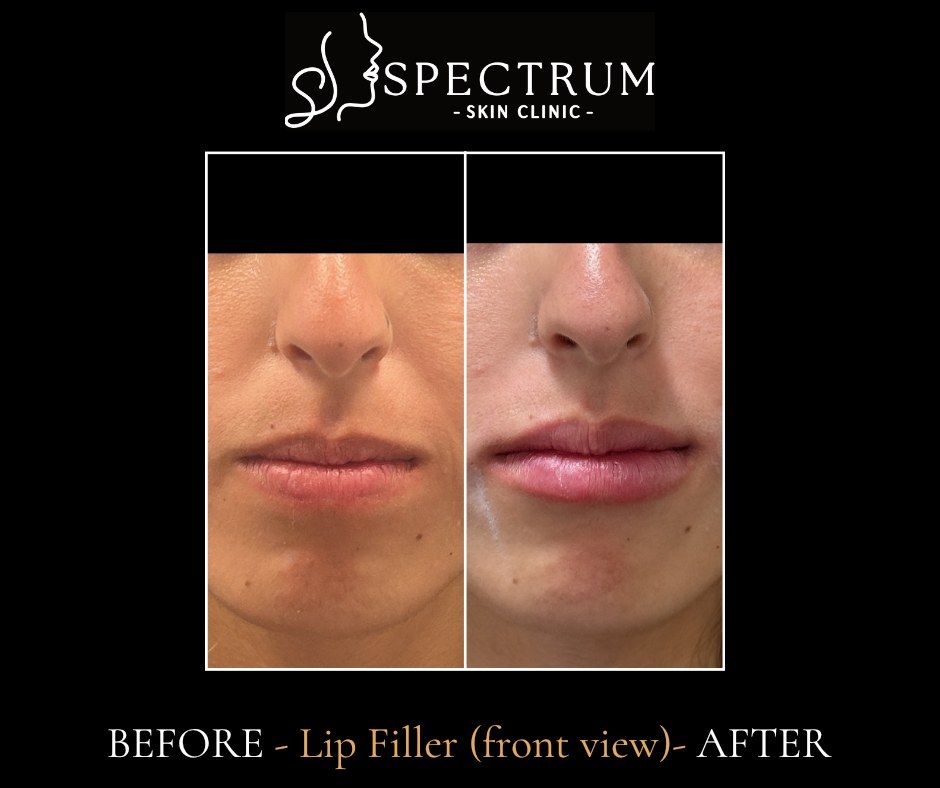 Lip Filler Before & After | Balanced Volume (Front View)