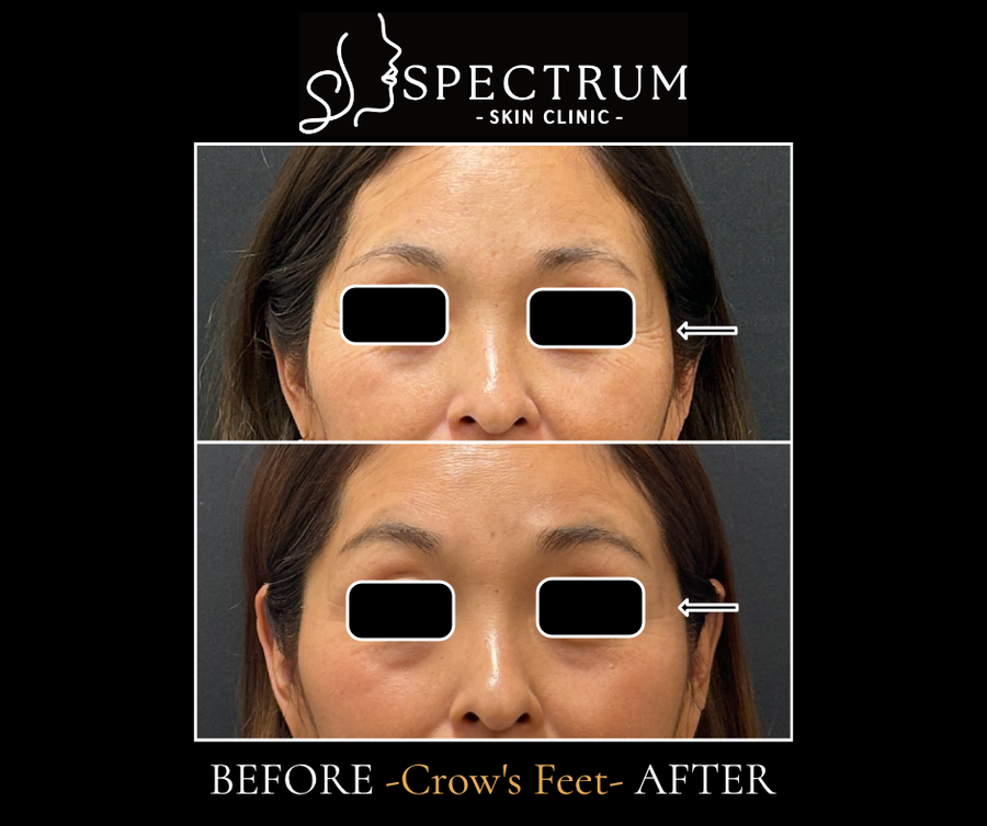 Botox for Crow's Feet Before & After | Smooth Eye Wrinkles Naturally