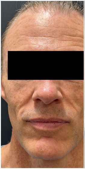 IPL Photofacial, Nordlys IPL before — sun spots, lentigines, photoaging, uneven skin tone, brown spots, male skin, front view
