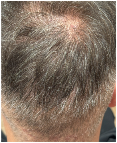 Exosome Hair Therapy after — Crown Thinning, Scalp Health, Reduced Hair Density, front view