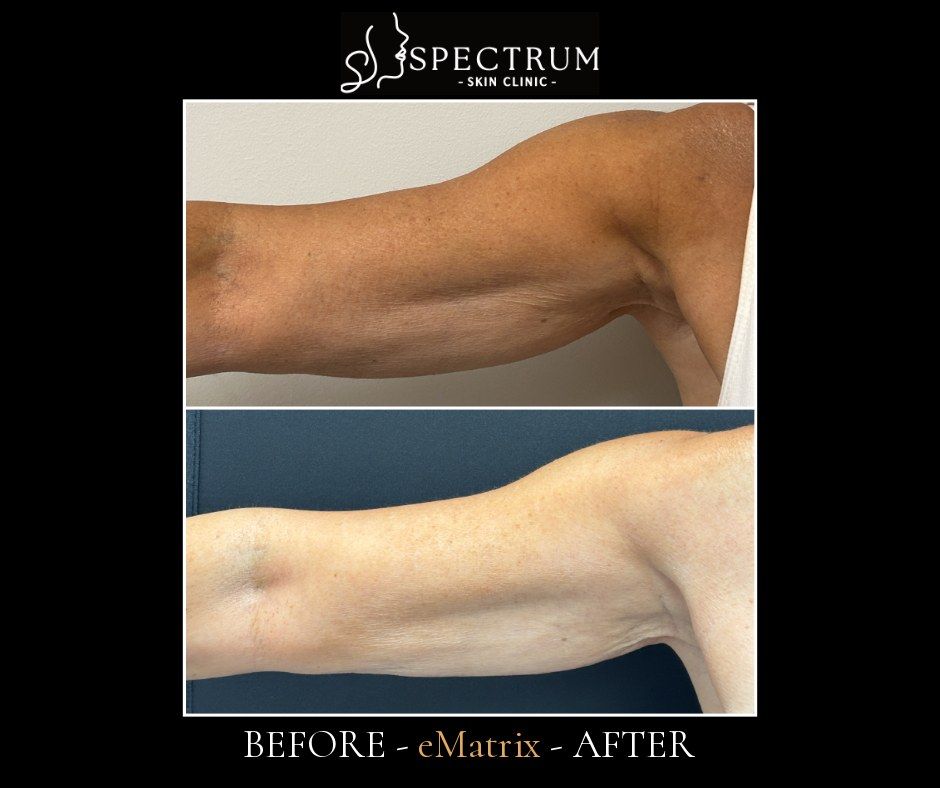 eMatrix Before & After | Upper Arm Crepey Skin