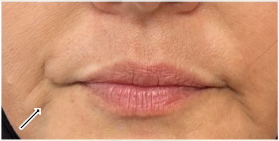 Filler Dissolve before — Marionette Lines, Lower Face Sagging, Filler Migration, front view