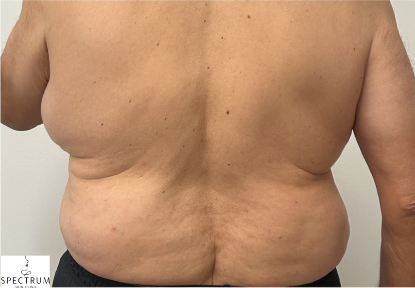 Body Cavitation before — Localized Fat, Body Contouring, Stubborn Fat Areas, front view