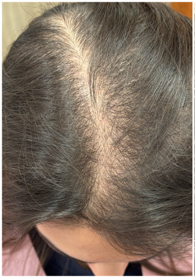 Exosome Therapy before — Crown Thinning, Vertex Thinning, front view