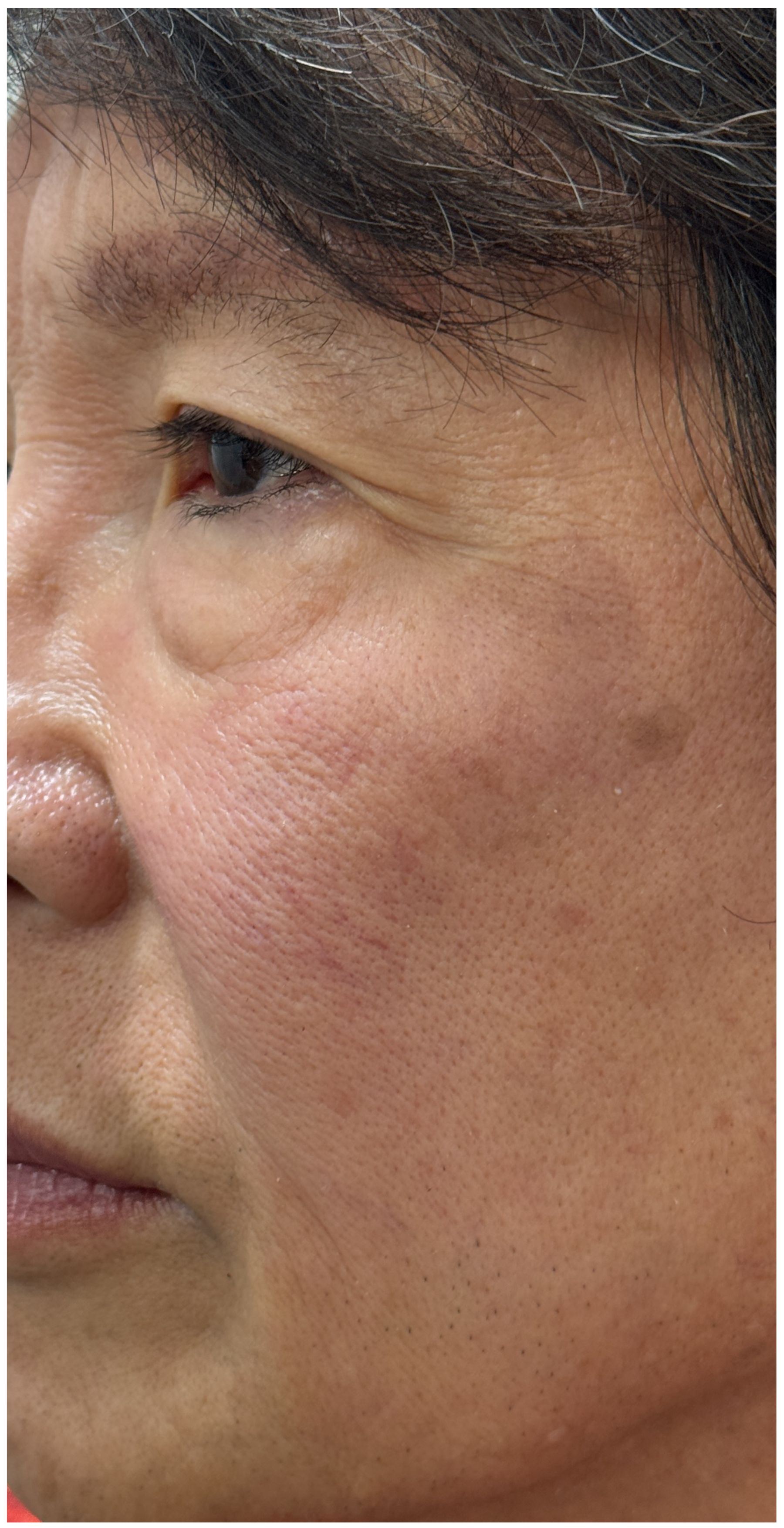 IPL Photofacial, Nordlys IPL after — Sun Damage, Hyperpigmentation, Solar Lentigines, Uneven Skin Tone, front view