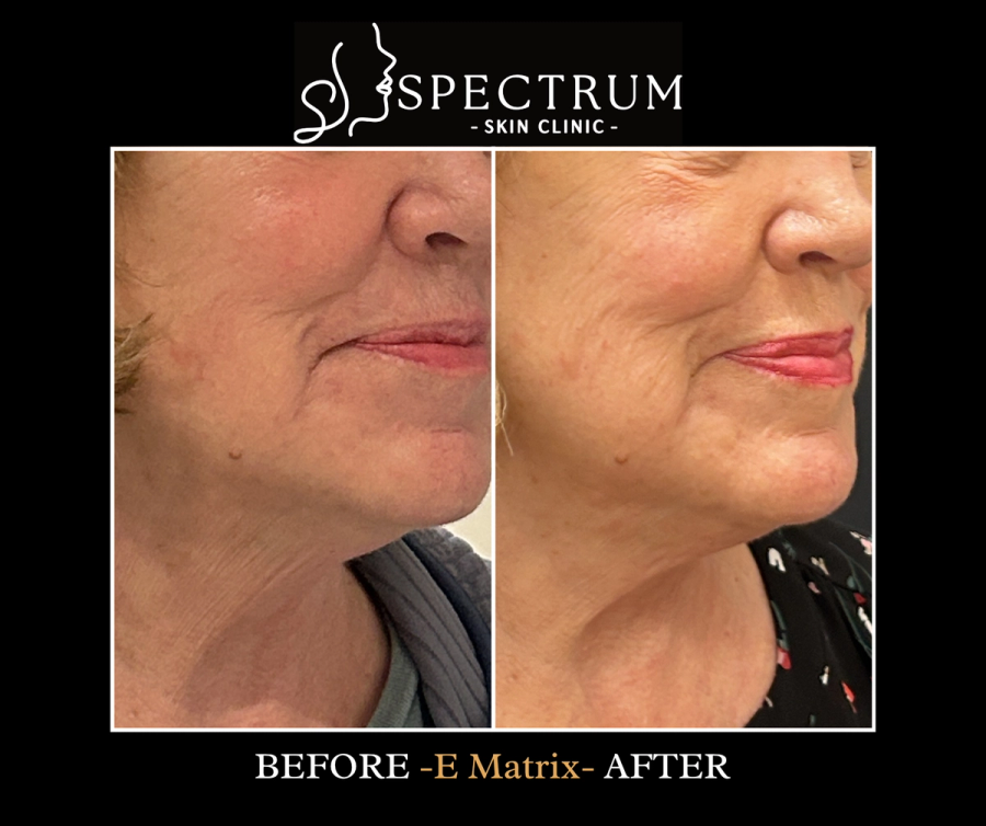 eMatrix Before and After | RF Skin Resurfacing Side Profile
