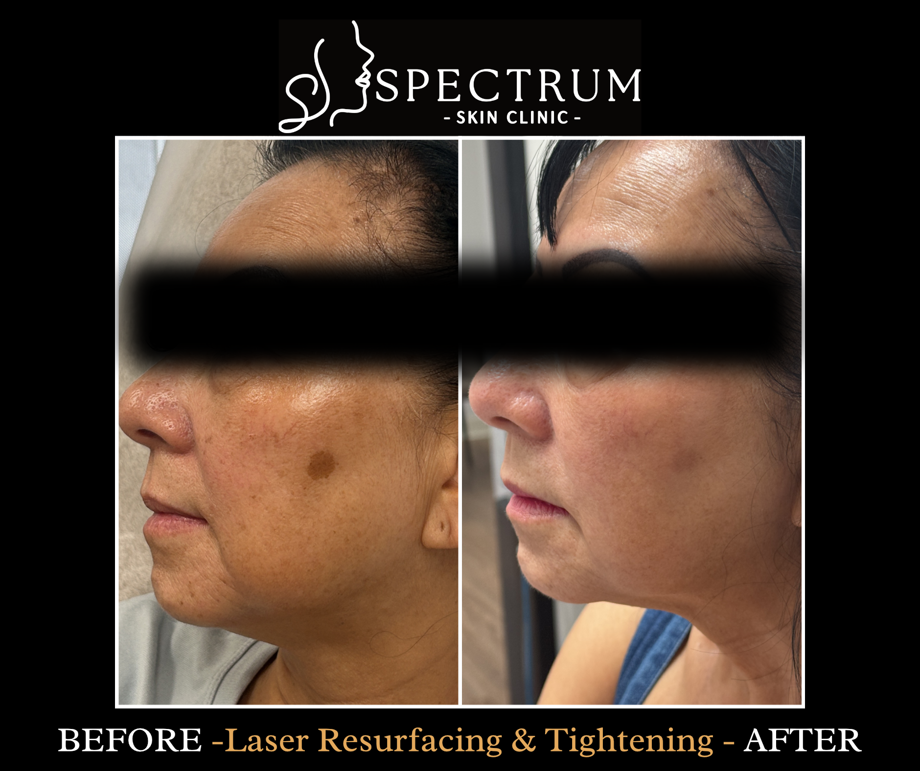 Laser Resurfacing Before & After | Skin Tightening and Brown Spot Improvement