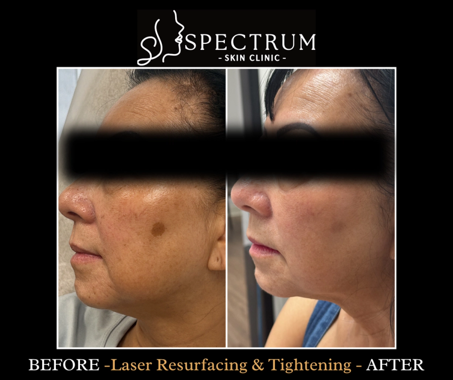 Laser Resurfacing Before & After | Skin Tightening and Brown Spot Improvement