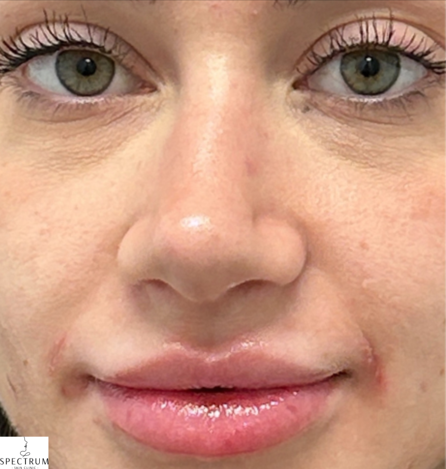 Lip Filler after — Lip definition, volume asymmetry, and mild dehydration, front view