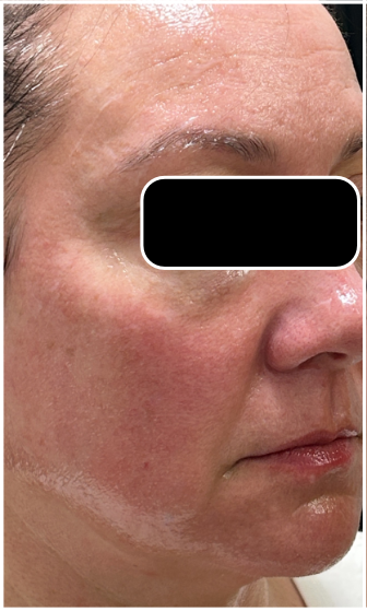 Light & Bright IPL before — Sun Damage, Hyperpigmentation, Uneven Skin Tone, Dullness, front view