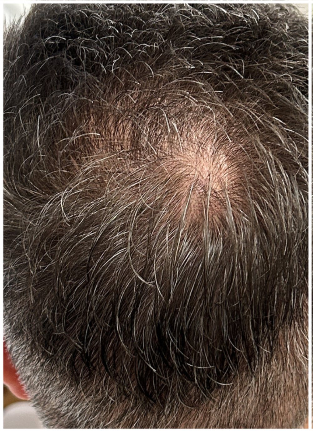 Exosome Hair Therapy before — Early-Stage Crown Thinning, Mild Hair Loss, Vertex Density Loss, front view