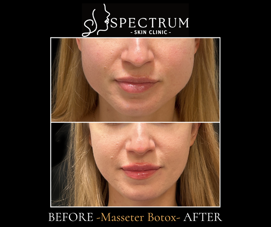Masseter Botox Before & After | Jawline Slimming and Facial Softening