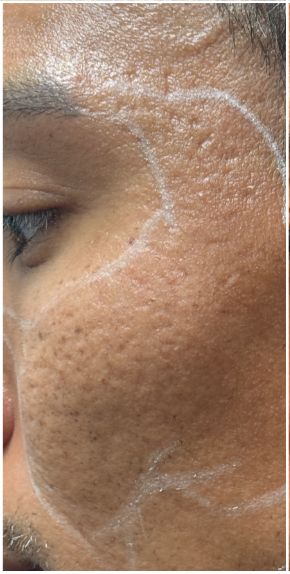 Fractional CO2, RF Microneedling, Subcision, Rejuran before — Atrophic Acne Scarring, Rolling and Boxcar Scars, Skin Texture, front view