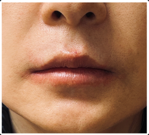 Lip Filler after — Thin Lips, front view