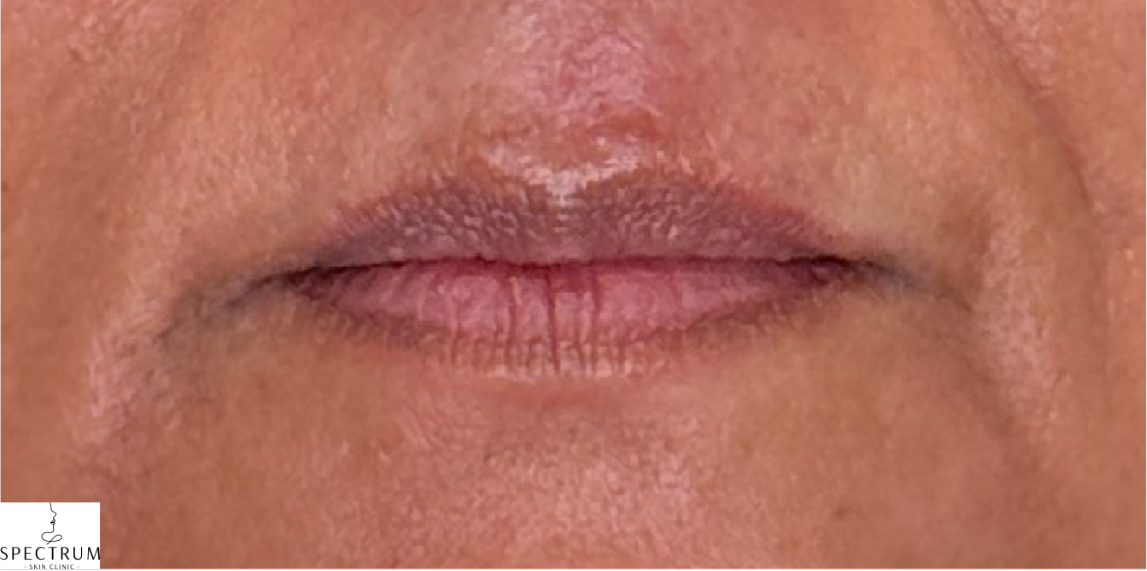 Lip Filler before — Volume Loss, front view