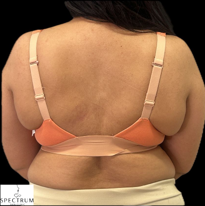Body Cavitation before — Bra Bulge, Upper Back Fat, Body Contouring, Localized Fat, front view