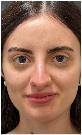 Masseter Botox before — Bruxism / TMJ, Wide Jawline, front view