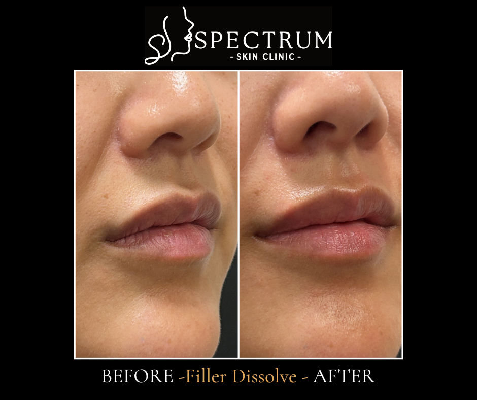 Lip Filler Dissolve – Side View (Migration Removal)