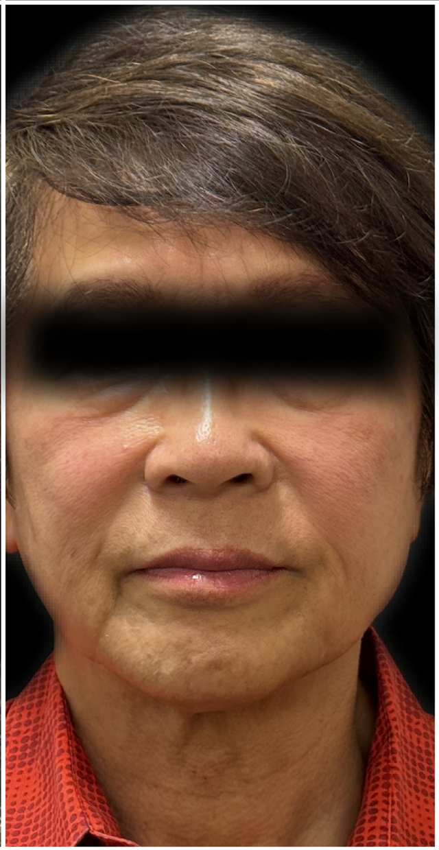 CO2 Laser Resurfacing Before & After | Skin Renewal in a Male Patient — after