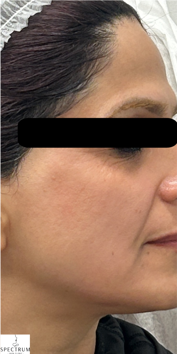 Secret PRO before — Fine Lines and Wrinkles, Uneven Texture, front view
