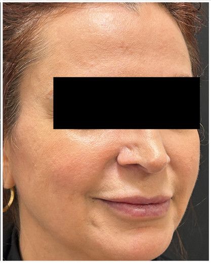 HIFU after — skin laxity, lower face sagging, jowl laxity, nasolabial folds, midface descent, front view