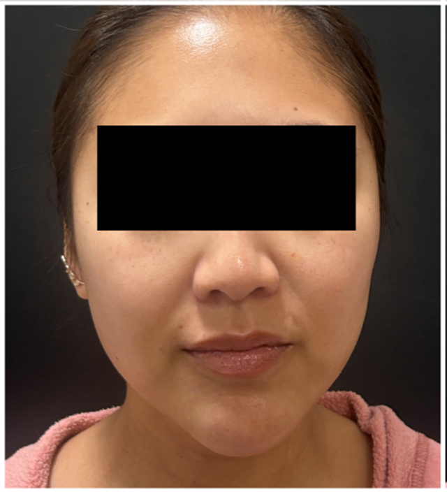 Cool Peel CO2 Before & After | Skin Texture, Tone and Enlarged Pores — before