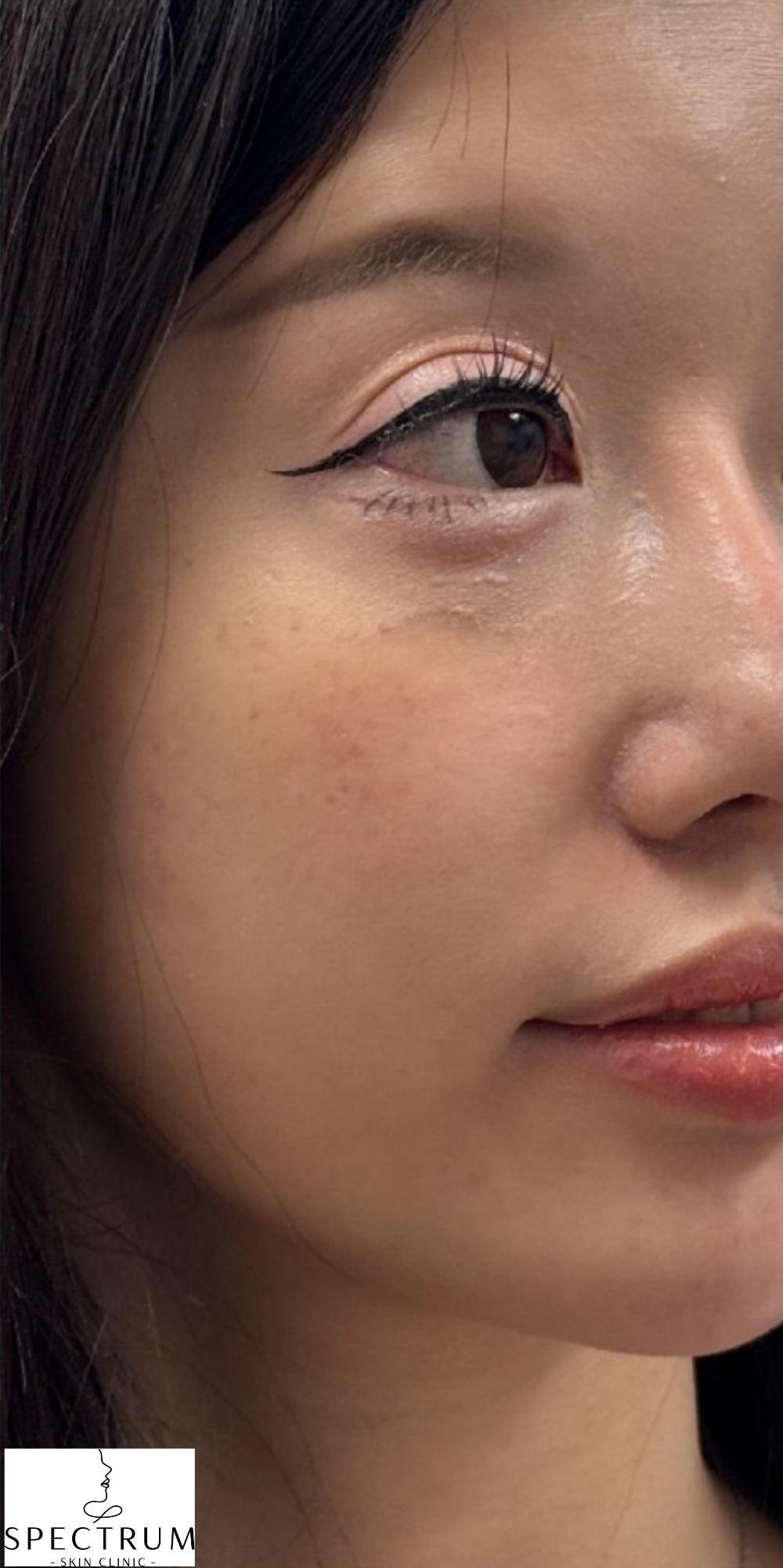 Filler Dissolve after — Filler Migration, Mid Face Heaviness, Pillow Face Appearance, Lower Face Heaviness, front view