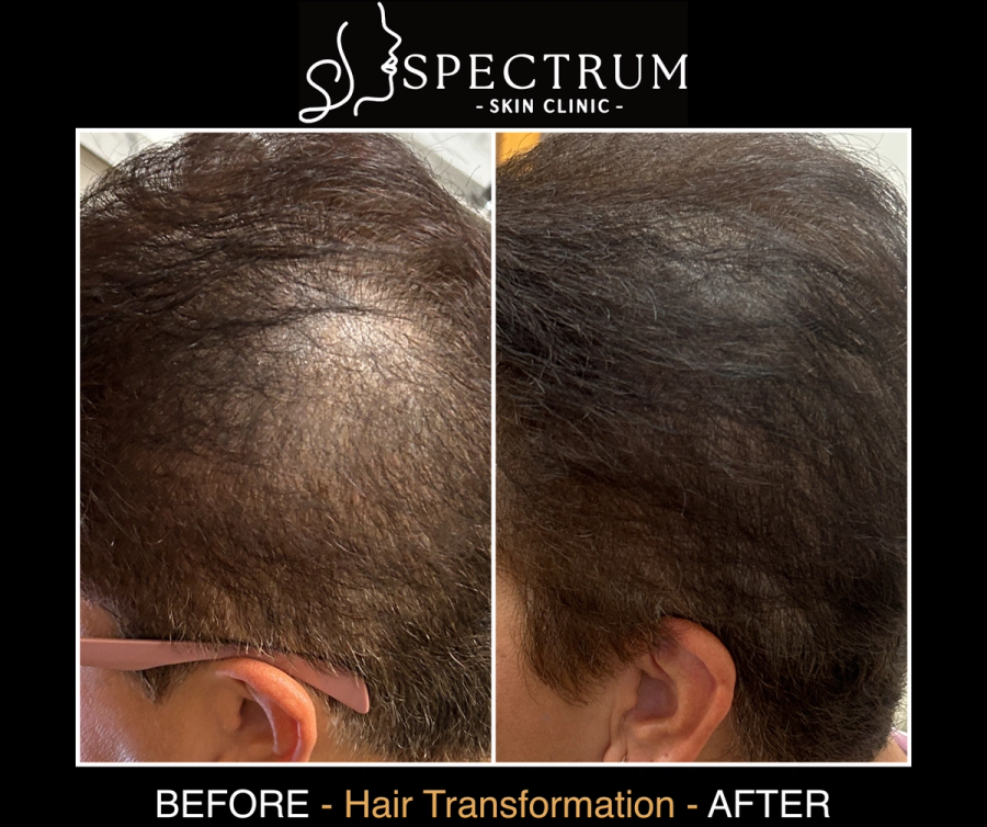 Exosome Therapy Before and After, Female Pattern Crown Density at Spectrum Skin Clinic, Irvine