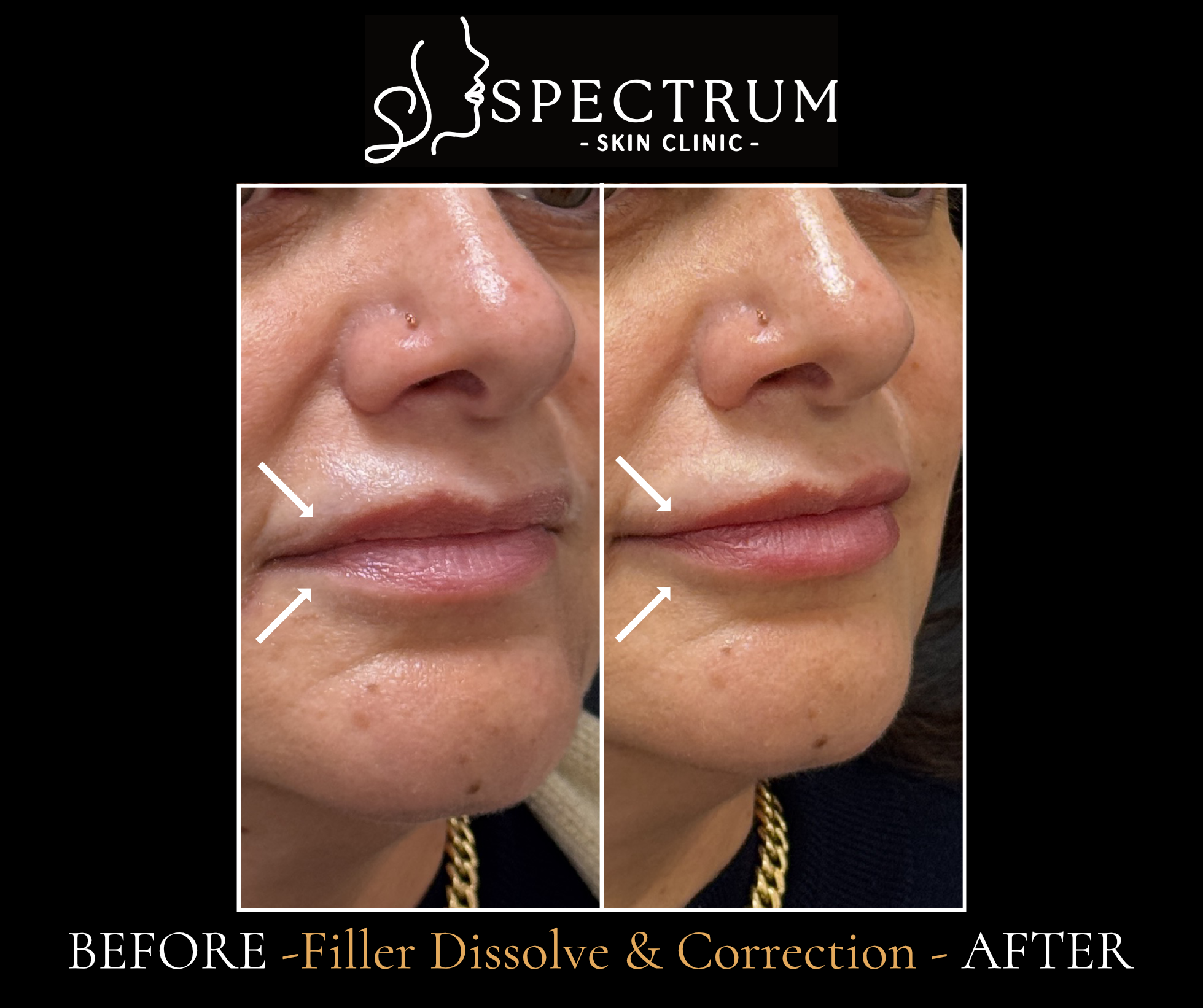 Lip Filler Dissolve Before & After | Correcting Migration & Uneven Lips