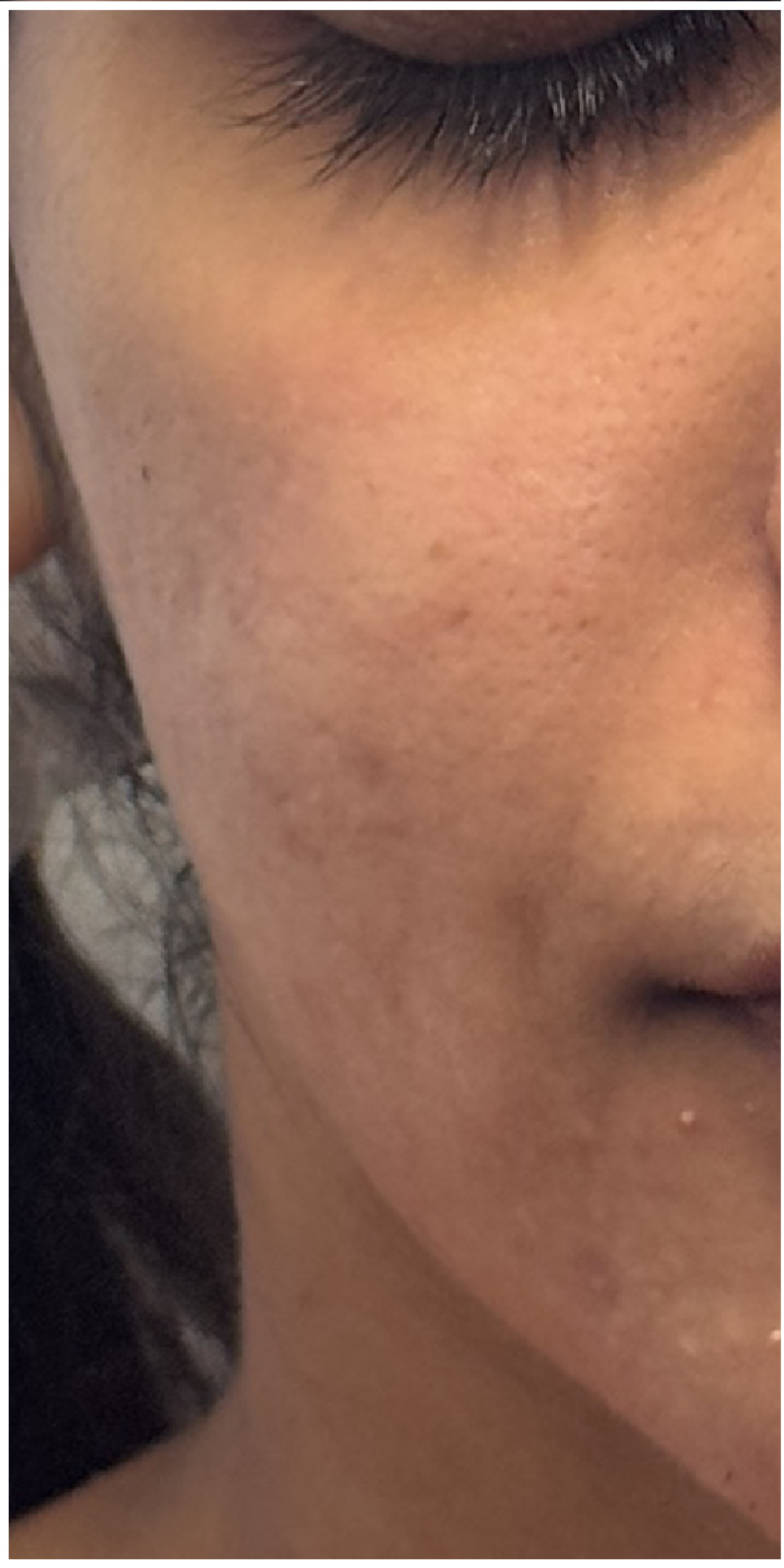 Secret PRO, TCA CROSS Peel before — Acne Scars, Uneven Texture, Hyperpigmentation, front view