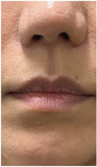 Lip Filler before — Lip Volume, Lip Definition, Lip Texture, front view