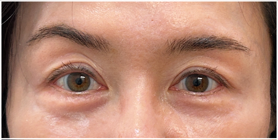 Filler Dissolve before — Under Eye Hollows, Filler Migration, Tear Trough Migration, front view