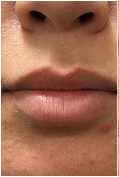 Lip Filler before — Thin Lips, front view