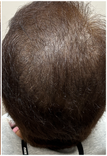 Exosome Hair Therapy after — Hair Thinning, Reduced Hair Density, Loss of Hair Volume, front view
