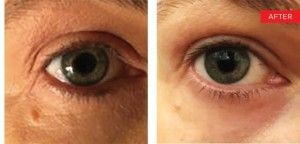Laser Under-Eye Tightening after — , front view