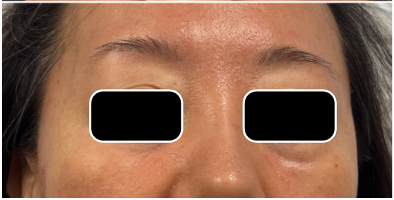 Under Eye Filler Dissolve after — Under Eye Hollows, Filler Migration, Tear Trough Migration, front view