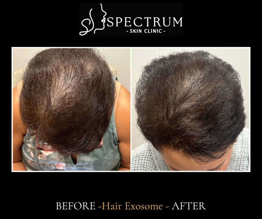 Exosome Therapy Before and After, Female Crown Density Restoration at Spectrum Skin Clinic, Irvine