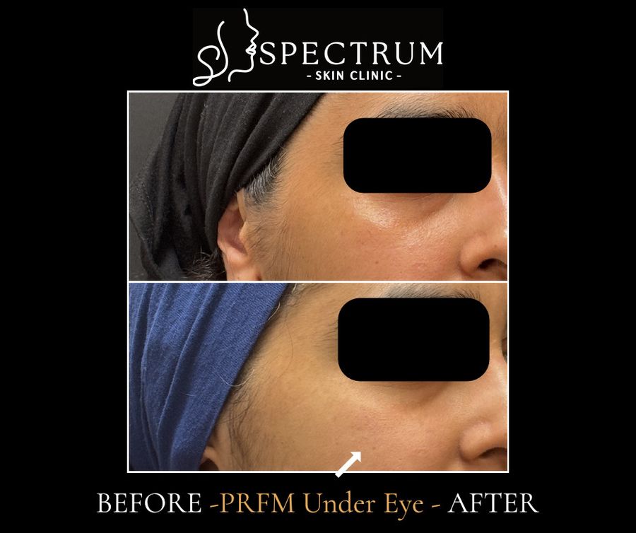 PRFM Under Eye Before & After | Lid-Cheek Smoothness and Volume (Oblique View)