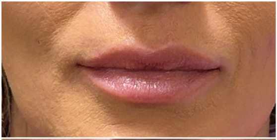 Lip Filler before — Thin Lips, front view