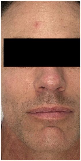 IPL Photofacial, Nordlys IPL after — sun spots, lentigines, photoaging, uneven skin tone, brown spots, male skin, front view