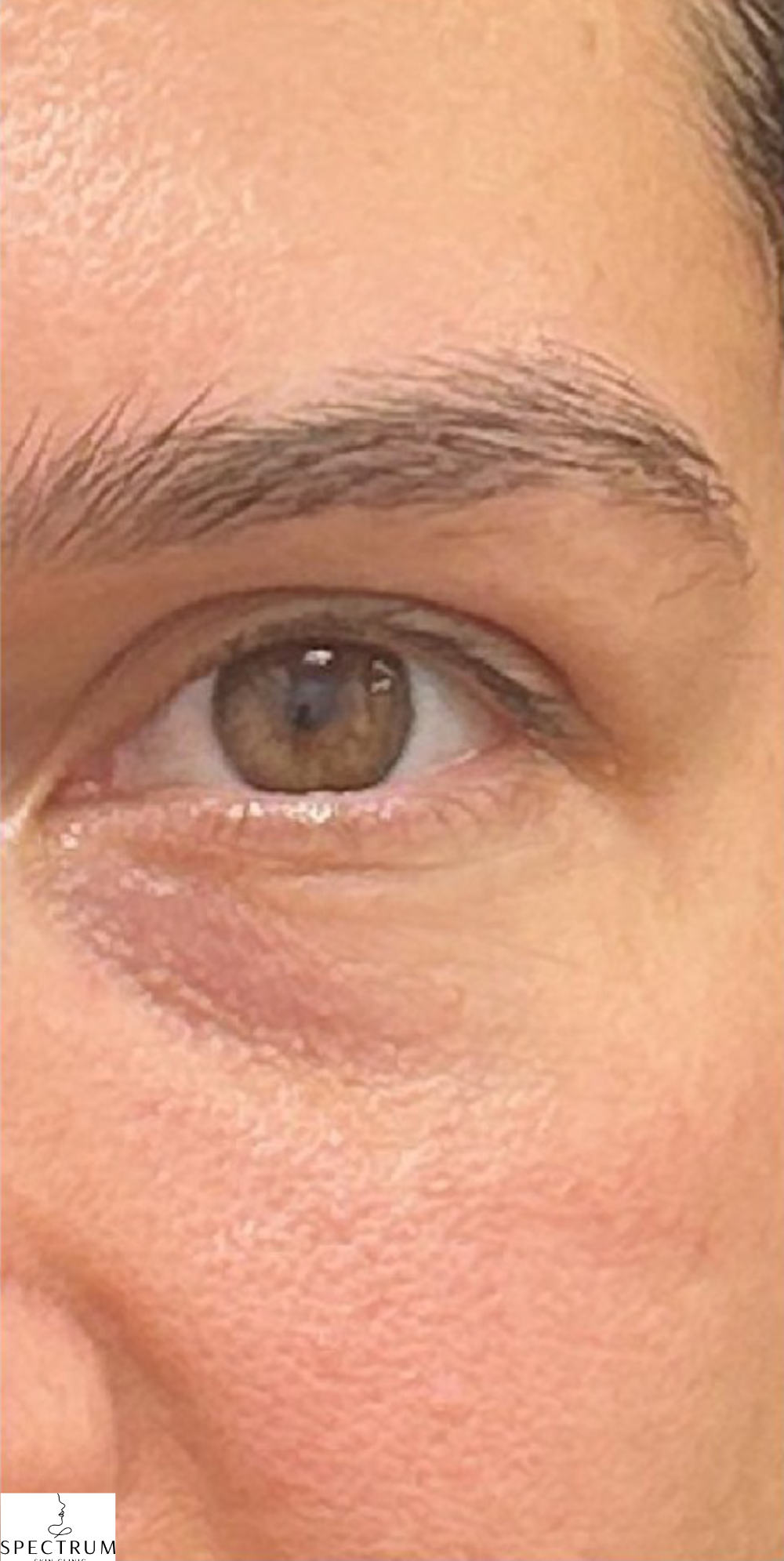 Rejuran PDRN after — Dark Circles, Fine Lines and Wrinkles, Crepey Eyelid Skin, Skin Quality, front view