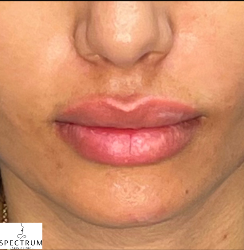 Lip Filler after — Thin Lips, front view